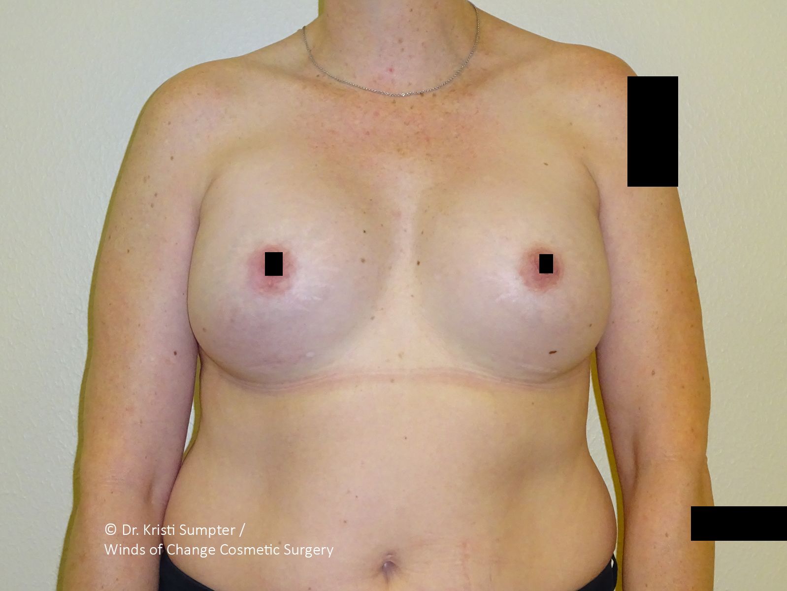 Torso of a person wearing a beige bra; nipples are covered with black squares.