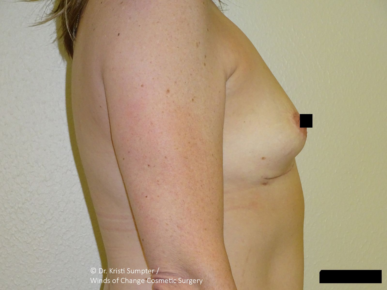 Side view of a person’s bare torso against a plain background, with black measurement markers.