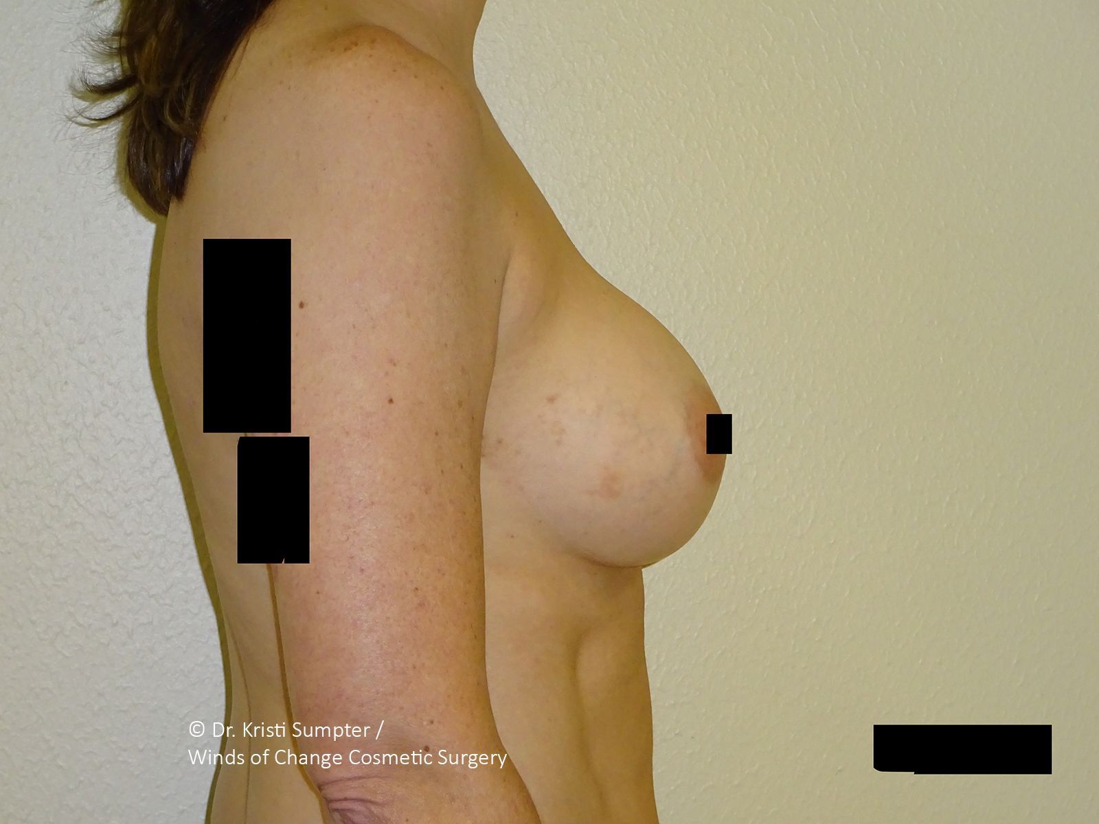 Side-view nude torso with black censor bars covering private areas against a plain wall