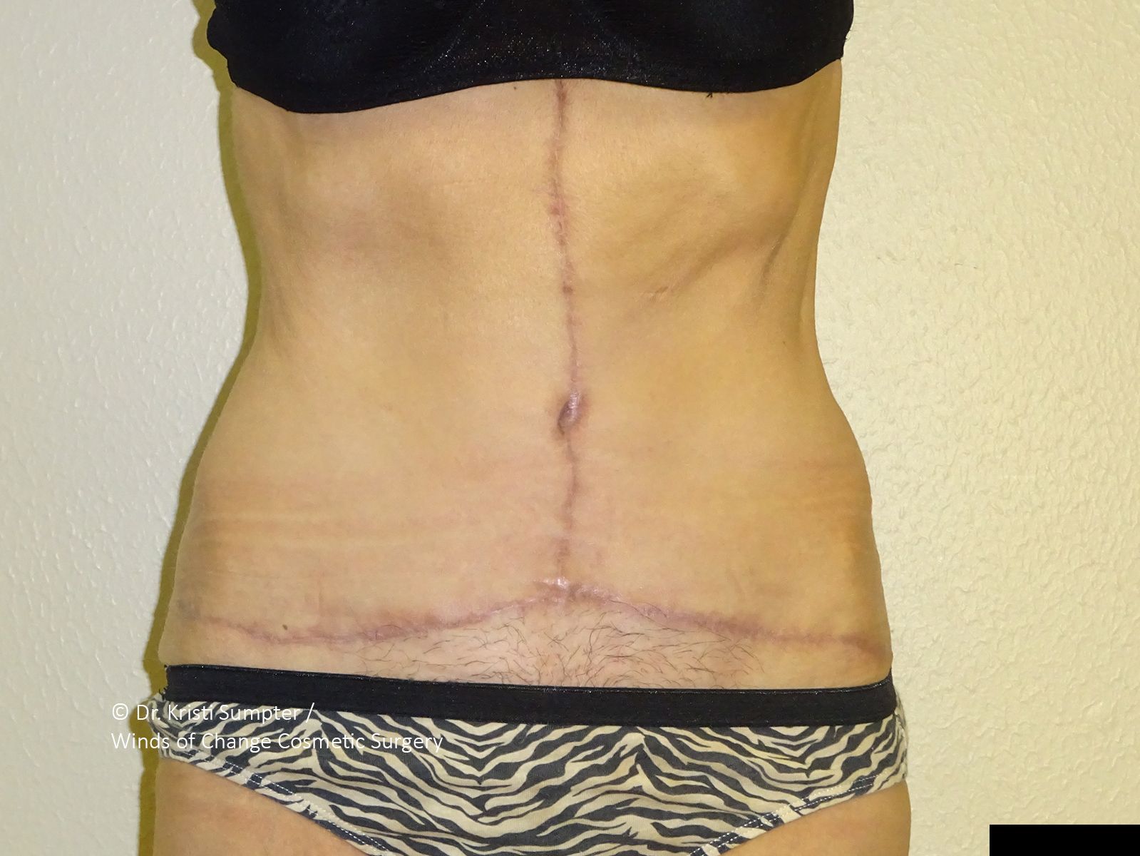Body of a person wearing pink underwear. Breasts and lower abdomen obscured. Light skin with freckles.