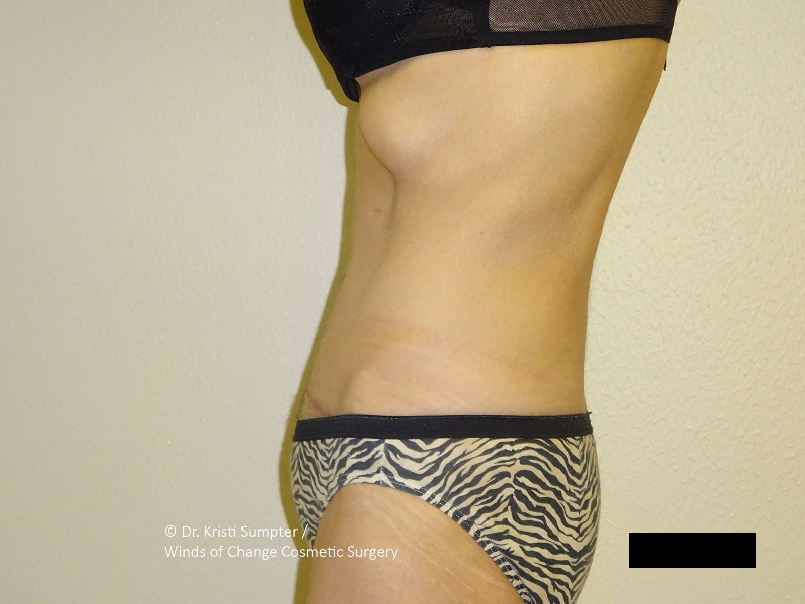 Profile view of a torso with marks and a pink bottom, parts obscured by black boxes.