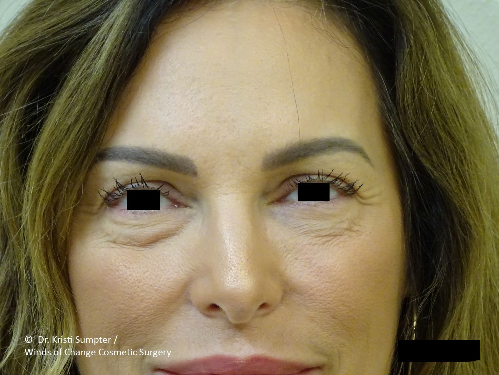 Before eyelid surgery, the woman's eyes looking forward