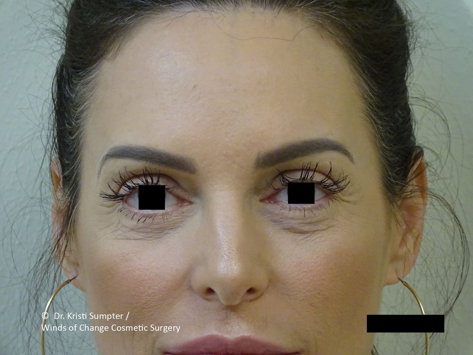 After eyelid surgery, the woman's eyes looking forward