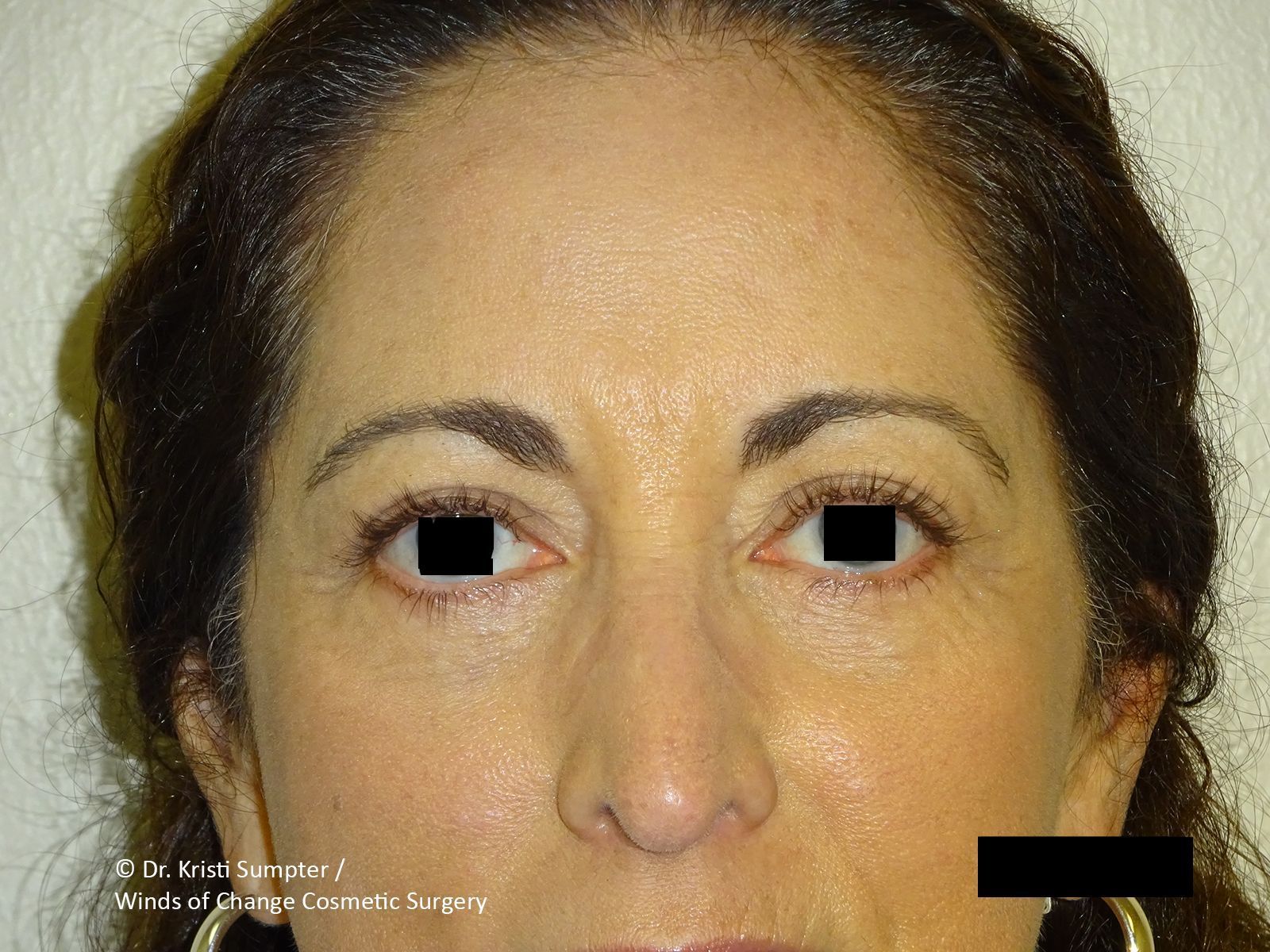 Close-up face with black bars obscuring the eyes and mouth