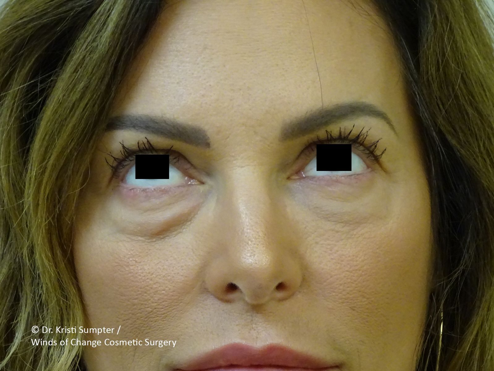 Before eyelid surgery, the woman's eyes looking upward