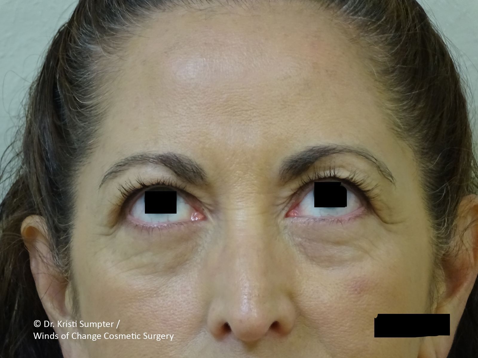 Close-up of a person's face with black boxes covering both eyes and one area on the cheek