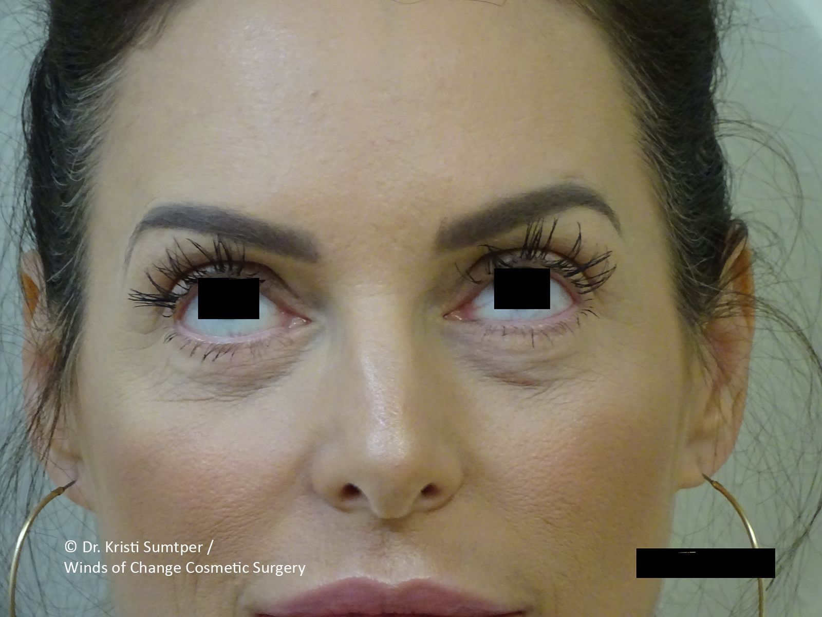 After eyelid surgery, the woman's eyes looking upward