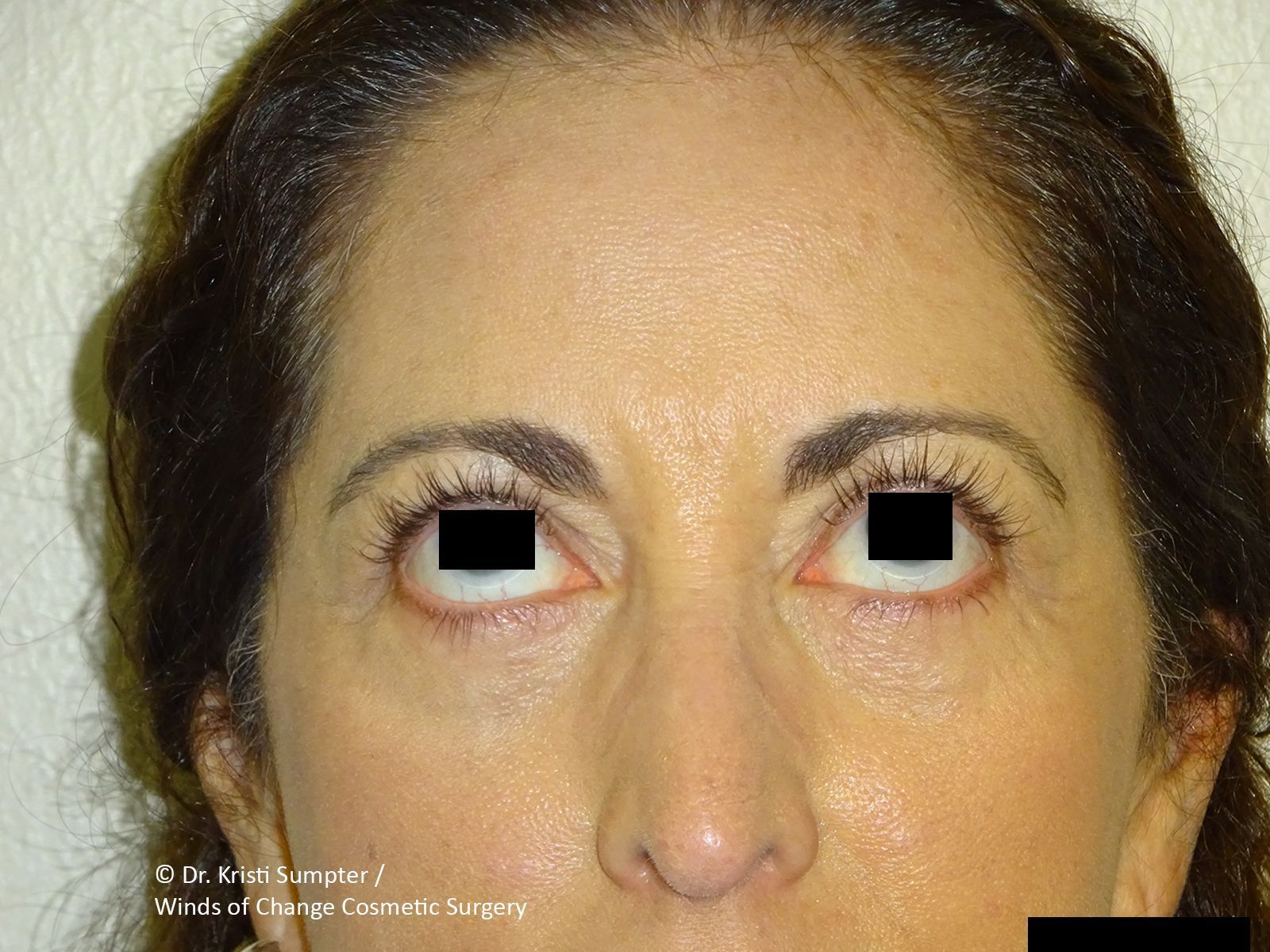 Close-up of a face with eyes rolled upward, showing red irritated eyelids.