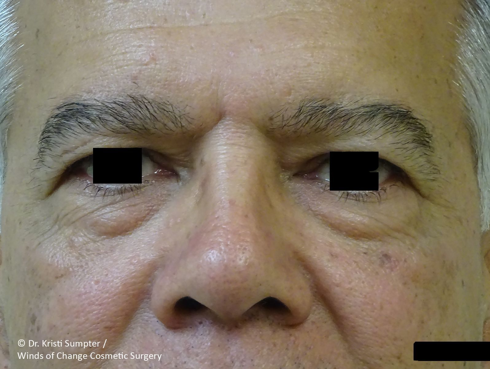 Close-up of a man's face looking forward before.