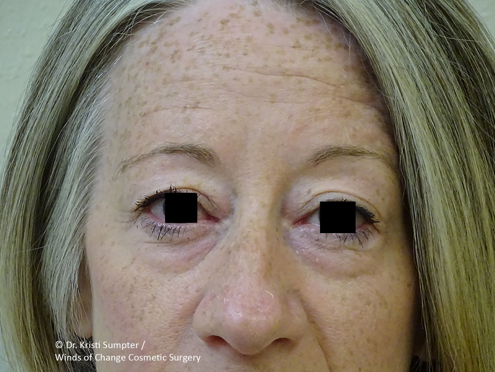Close-up of a woman's face looking forward before.