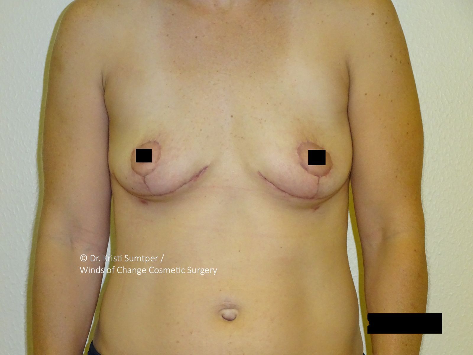 A person's torso with the breasts visible after breast surgery; scars are present.