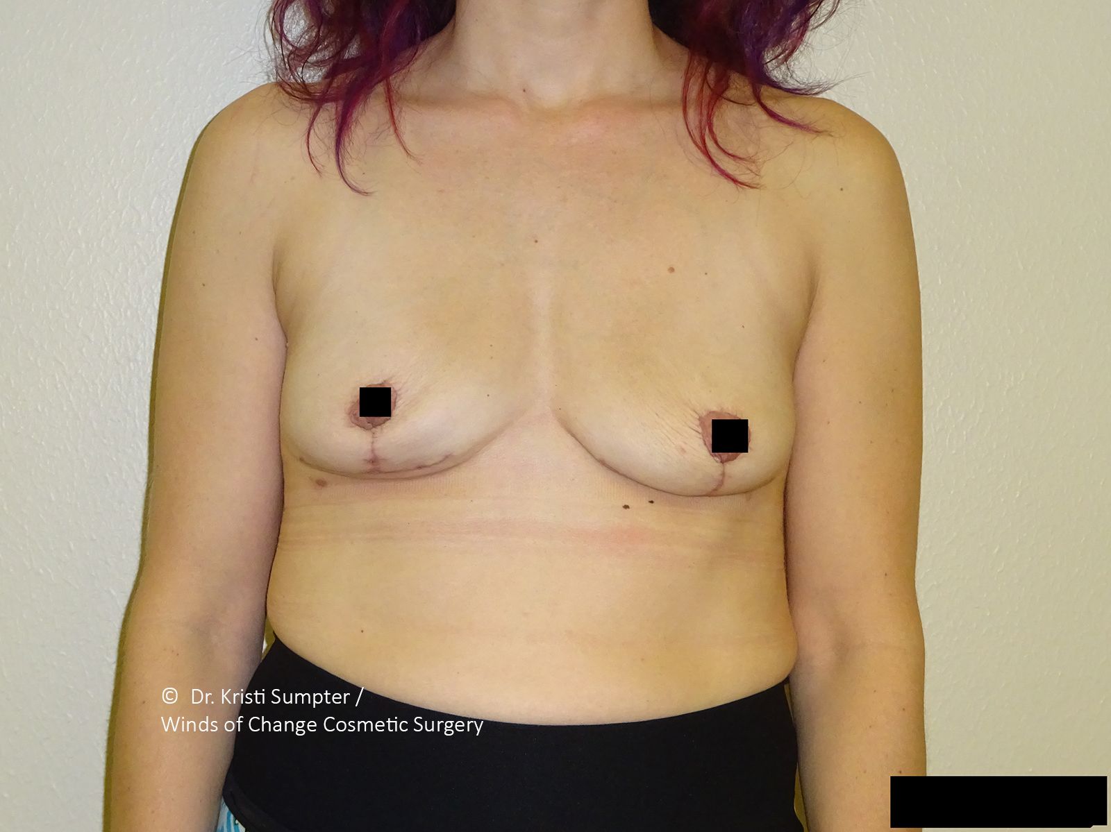 Torso of a person with post-surgical breasts; black squares over nipples. Vertical scar visible under each breast.