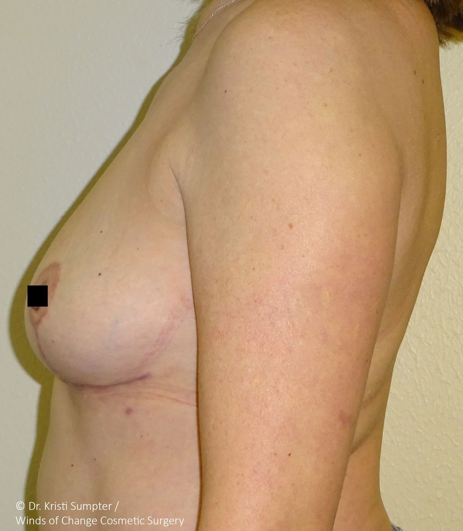 Side view of a torso showing a breast and scar, likely after surgery. The nipple is obscured by a black box.