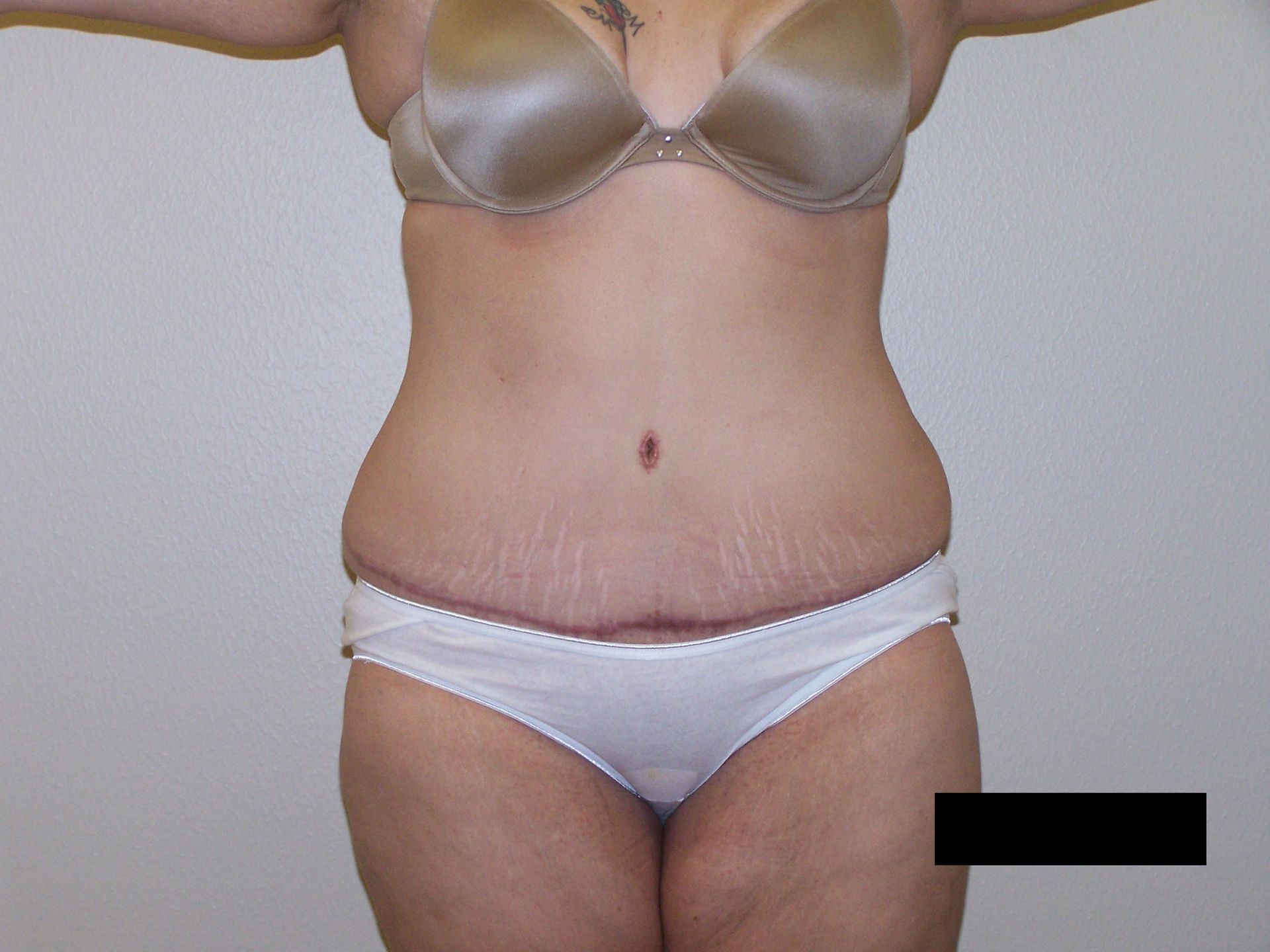 Torso with surgical scars, wearing underwear and a top; belly button visible.