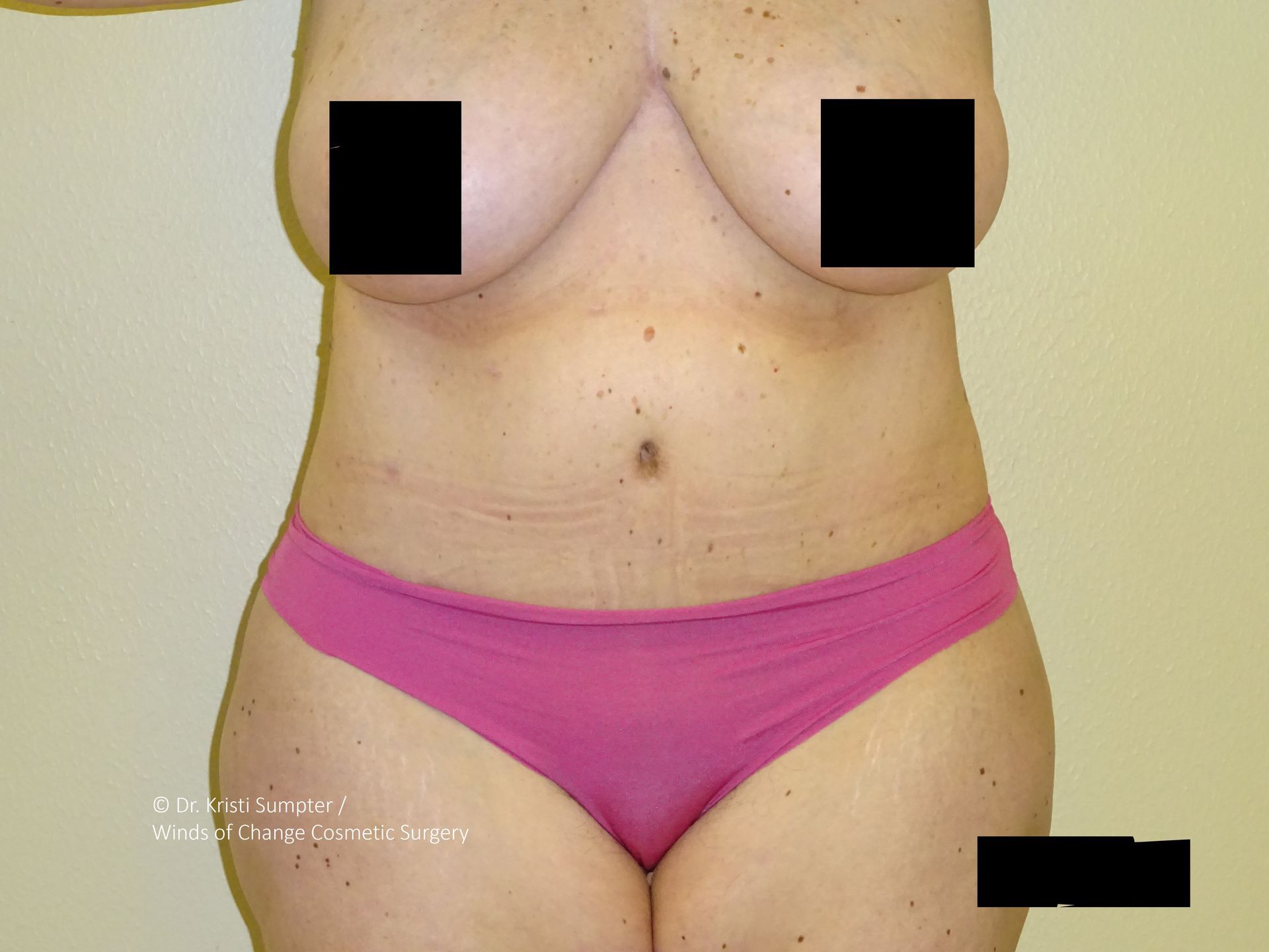 Body of a person wearing pink underwear. Breasts and lower abdomen obscured. Light skin with freckles.