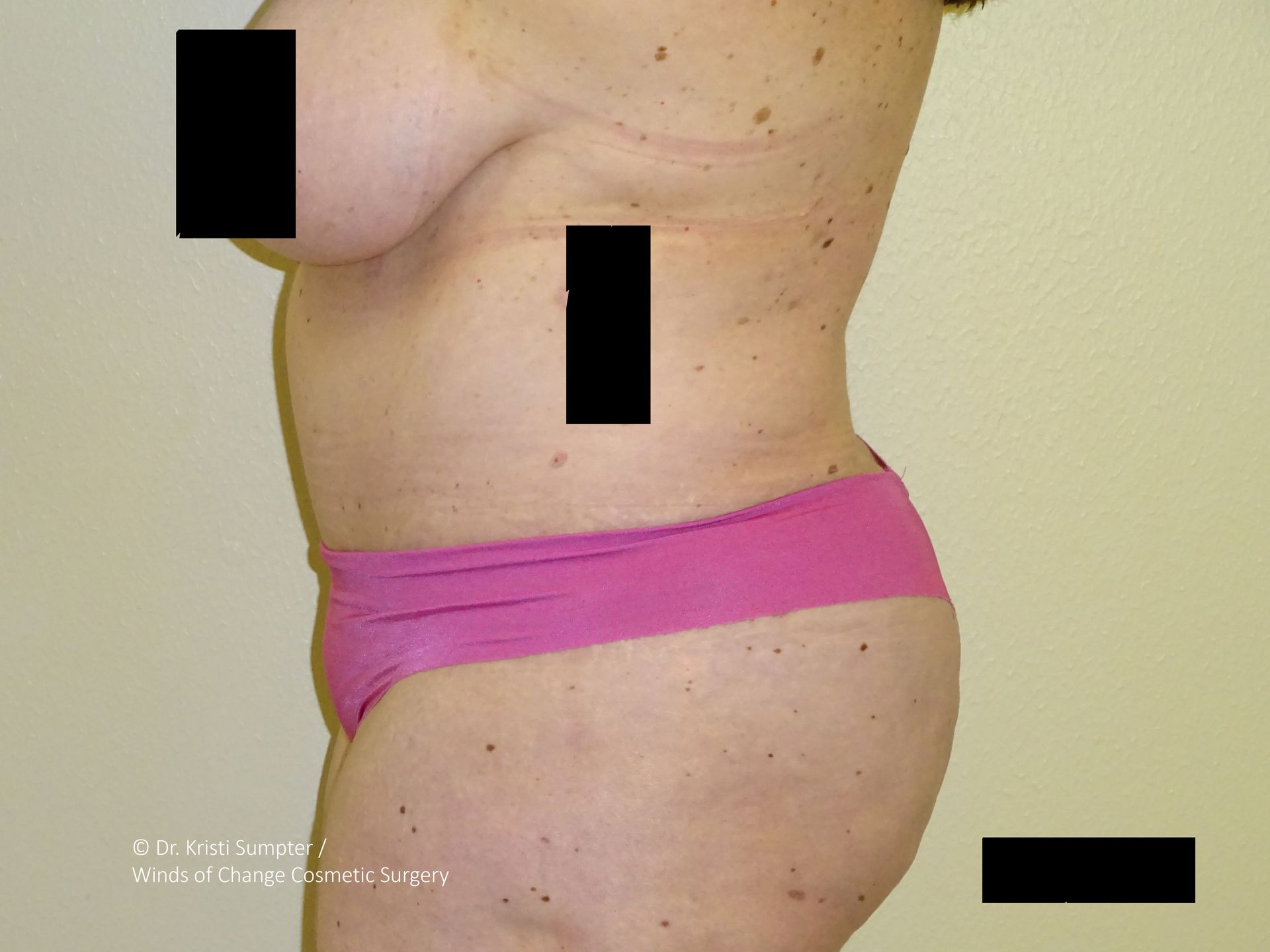 Profile view of a torso with marks and a pink bottom; parts obscured by black boxes.
