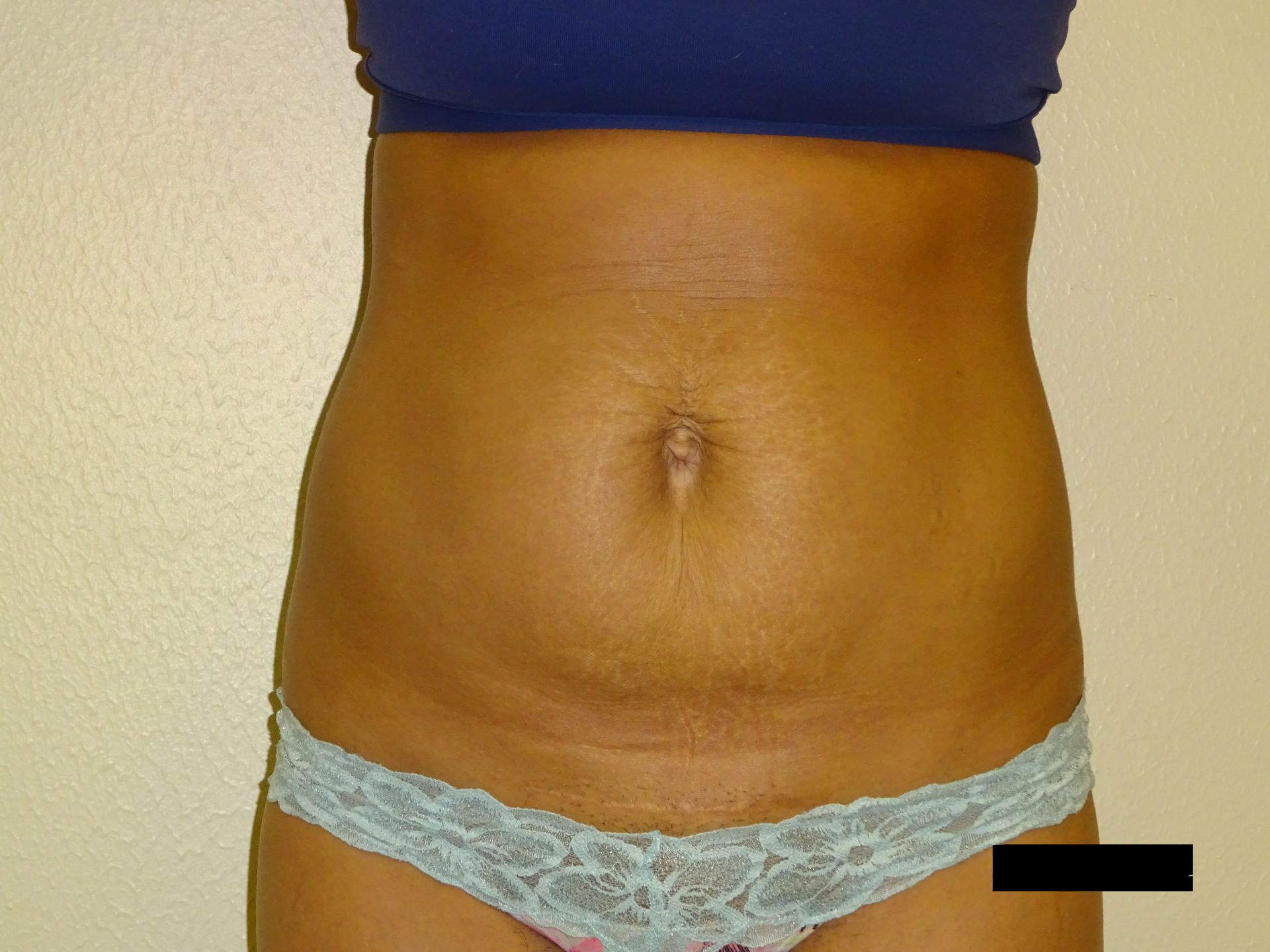 Torso with stretch marks on abdomen wearing blue top and lace underwear.