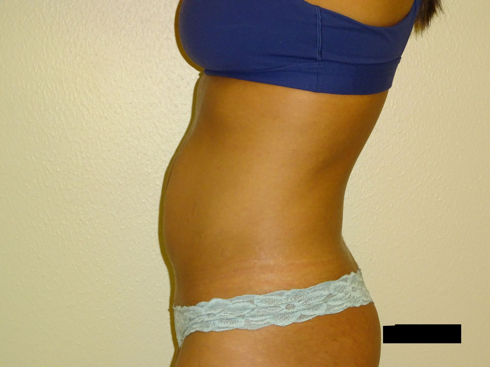 Side view of a torso in a blue sports bra and light blue underwear; skin with stretch marks.
