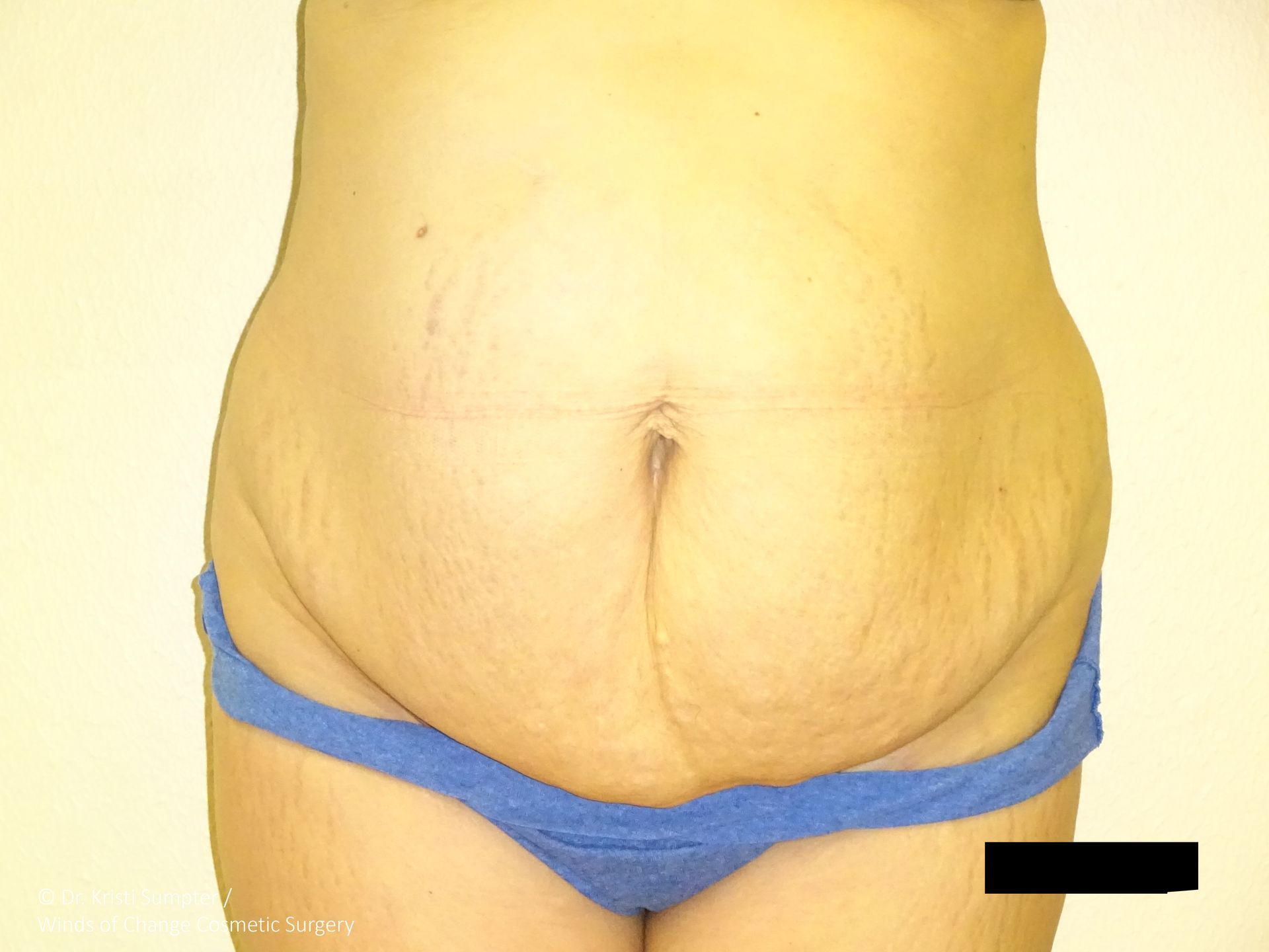 A person's abdomen, visible from the mid-chest to above the hips, with loose skin and stretch marks, wearing blue underwear.