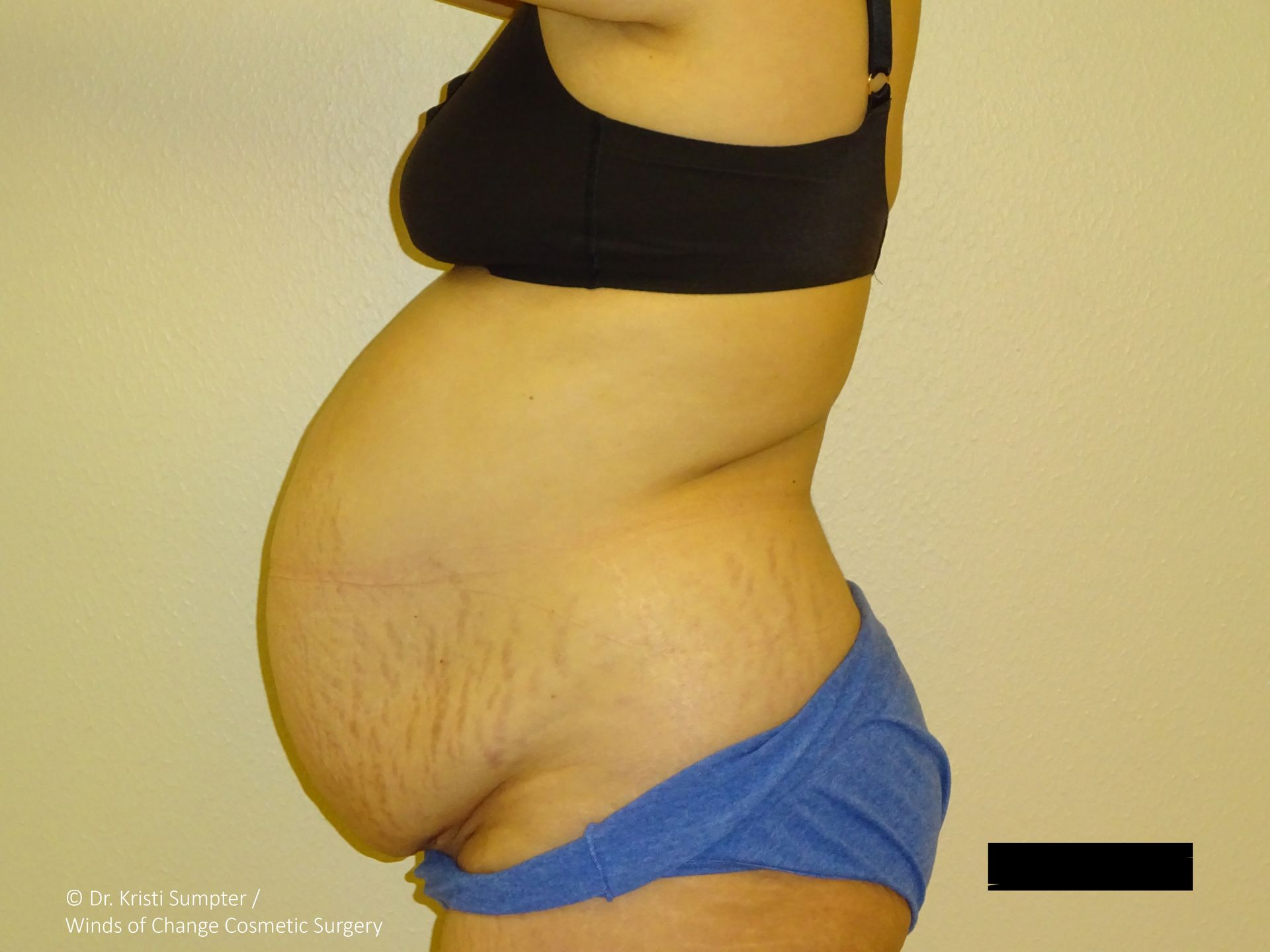 Side view of a person wearing a black bra and blue underwear, showing a large abdomen with stretch marks.