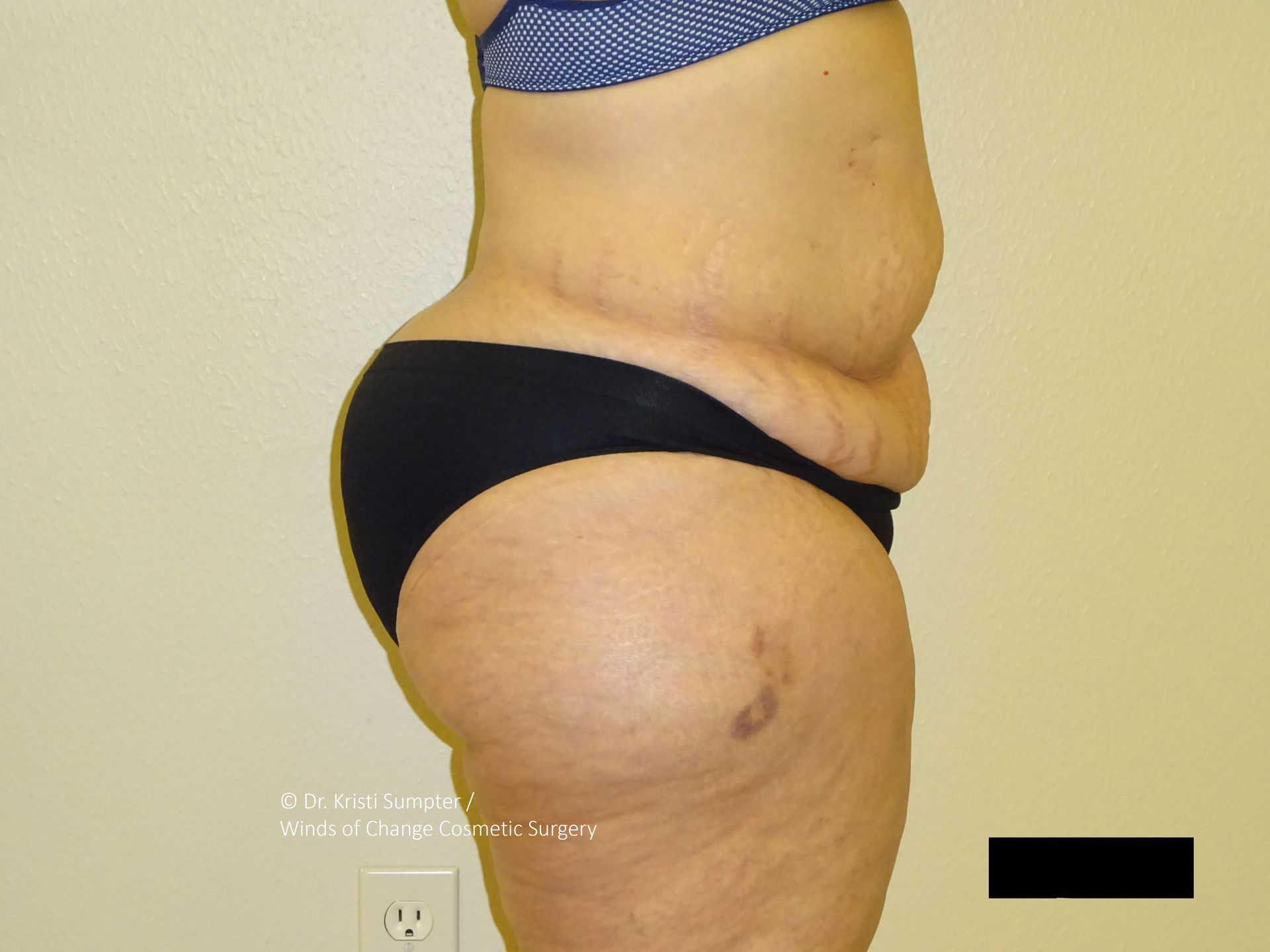 Side view of a person wearing underwear, showing the lower torso, thigh, and buttock area, with skin imperfections.