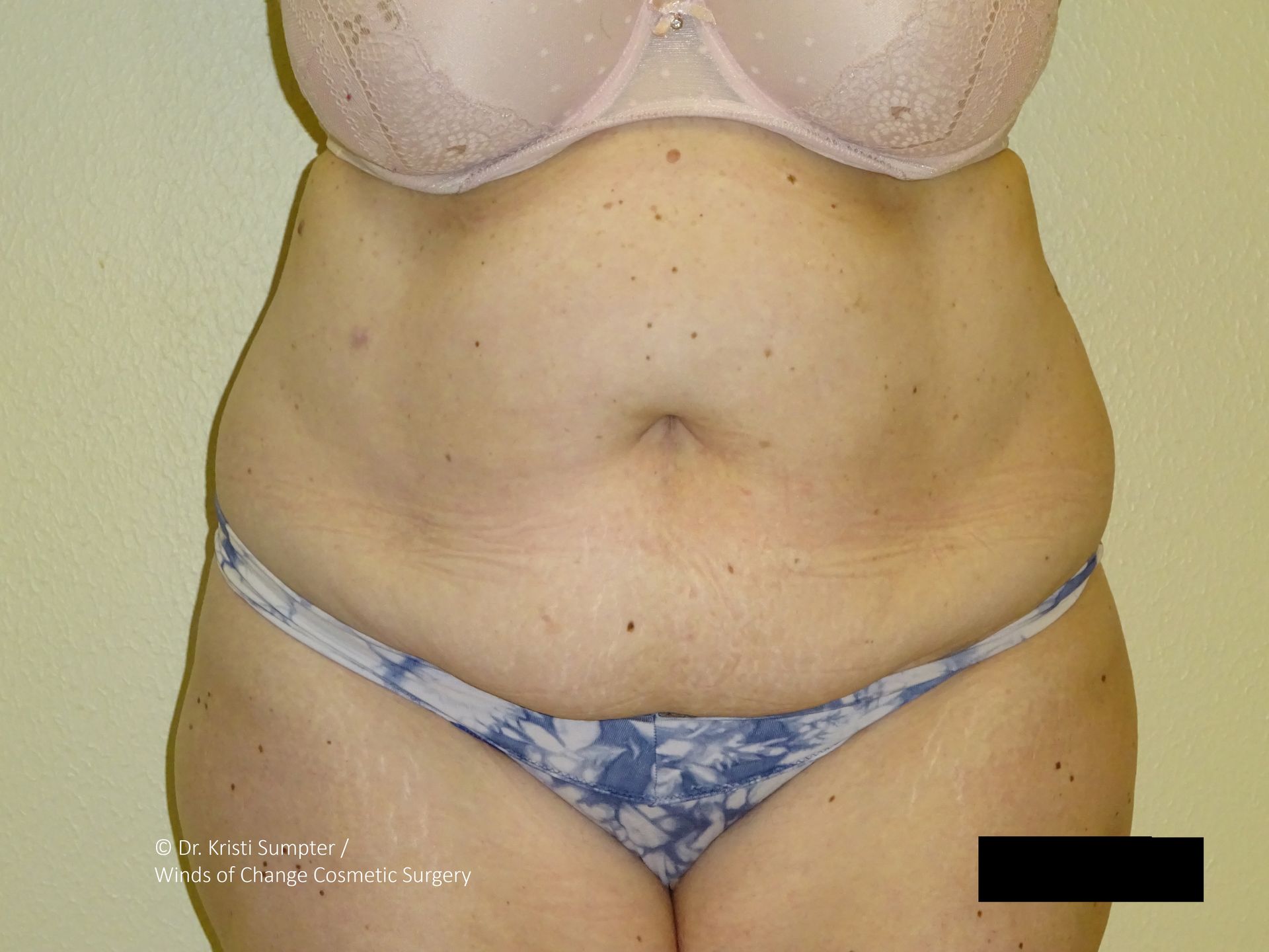 Torso of a person wearing a bra and patterned underwear, showing skin with stretch marks and small freckles.