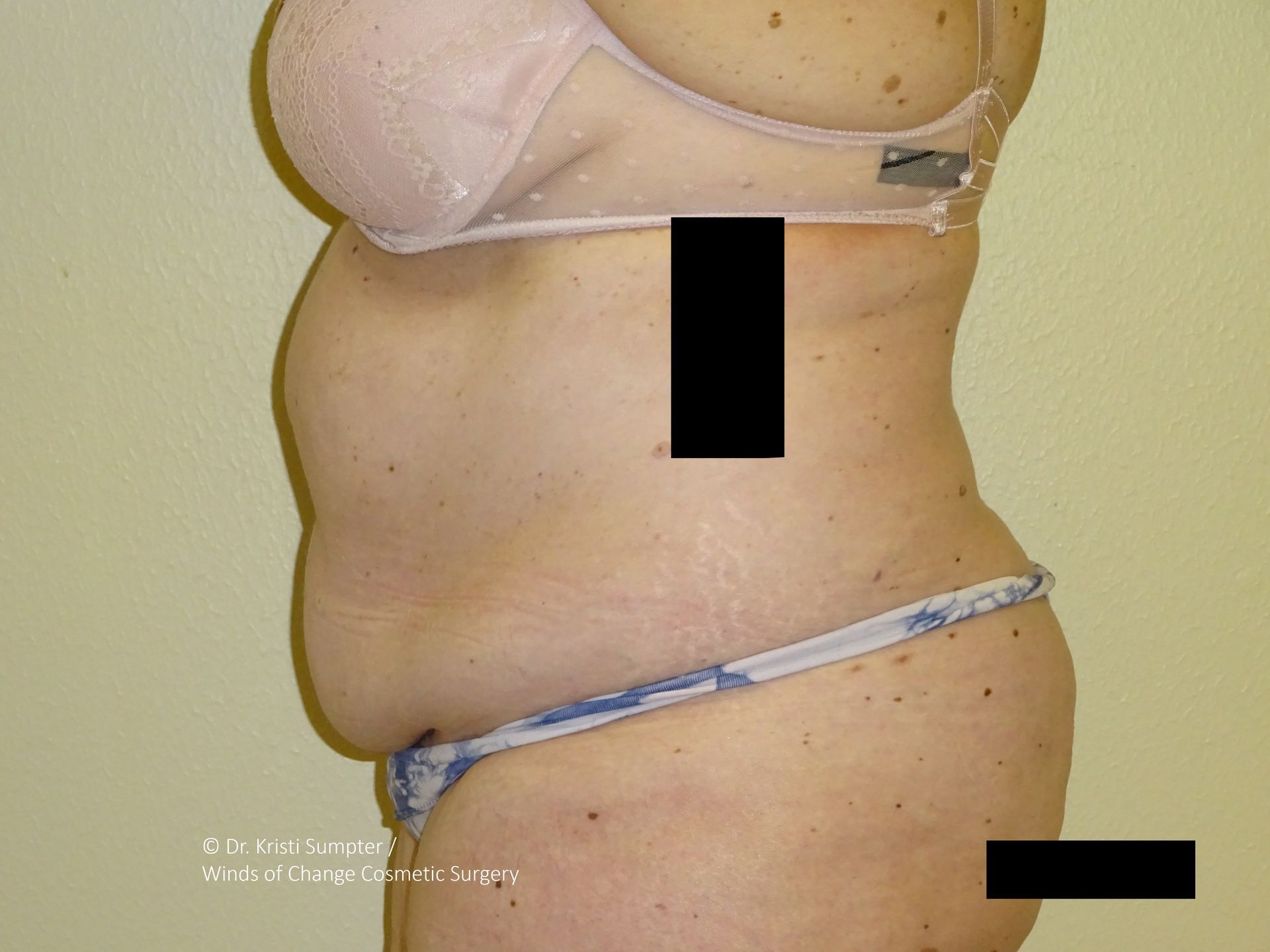 Side view of a person wearing a bra and bikini bottoms, with visible skin folds and some discoloration.