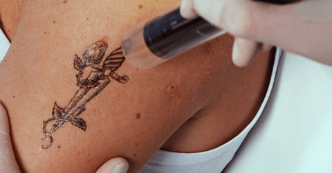 Removing tattoo