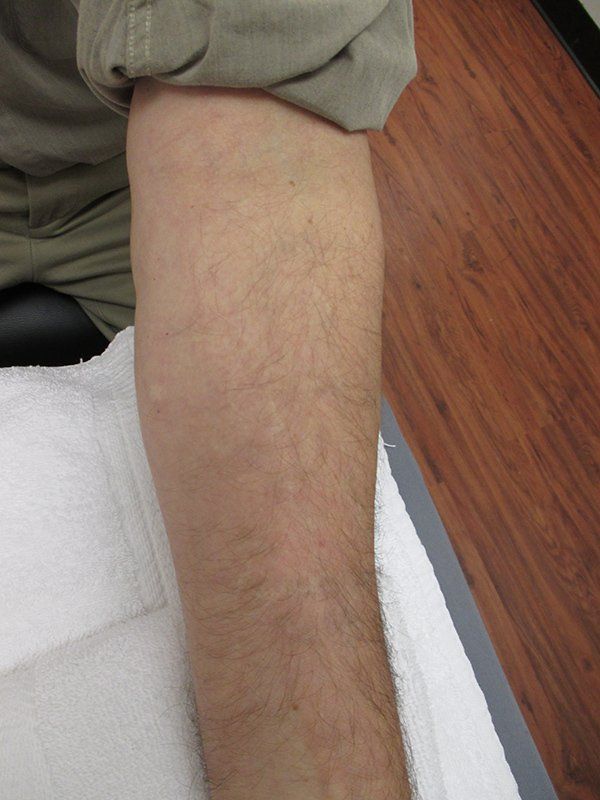 Forearm
