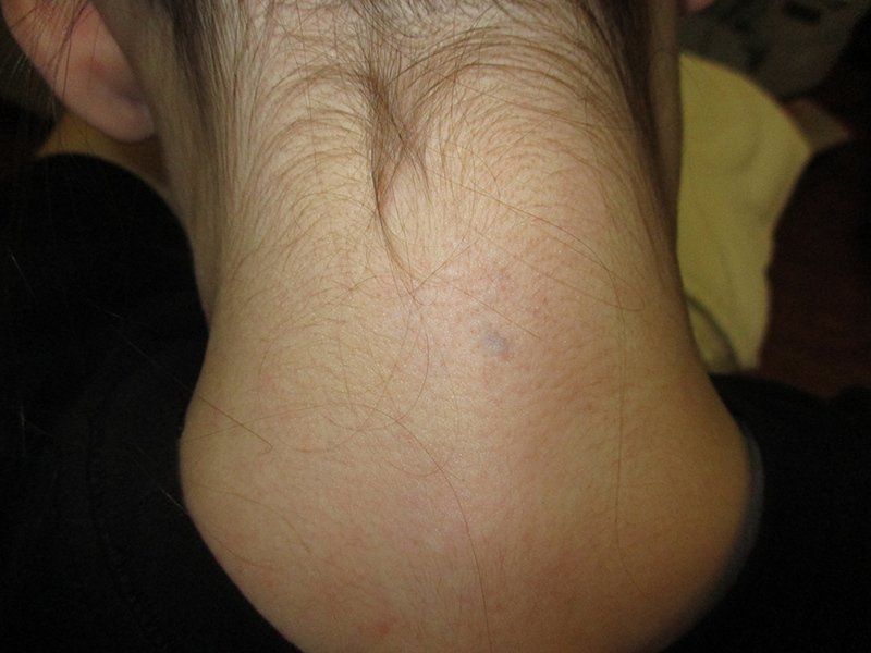 Nape