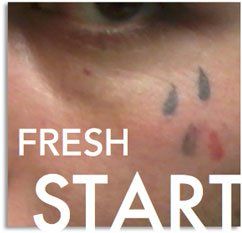 Laser Tattoo Removal  Image Enhancement Center