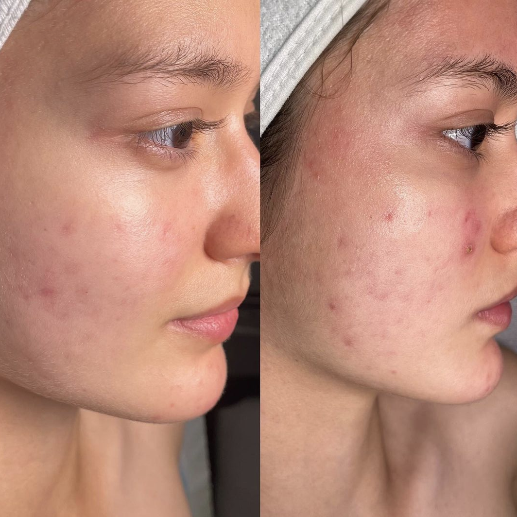 A before and after picture of a woman's face with acne.