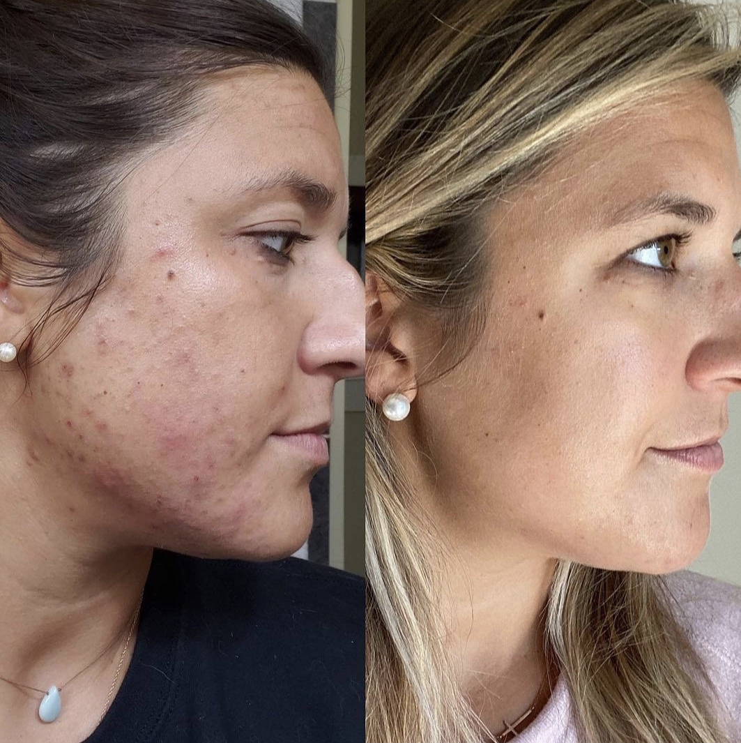 A before and after photo of a woman's face.