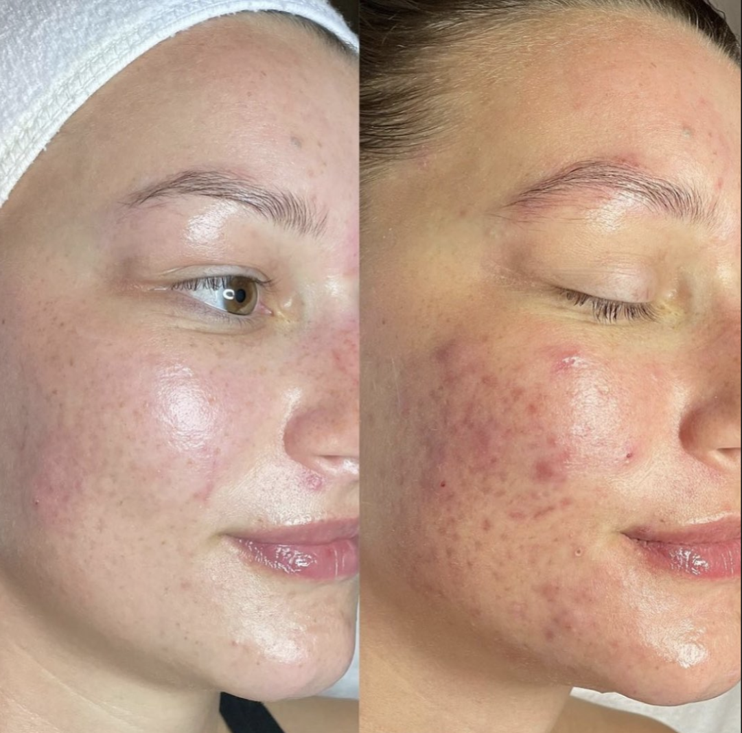 A woman's face is shown before and after a facial treatment.