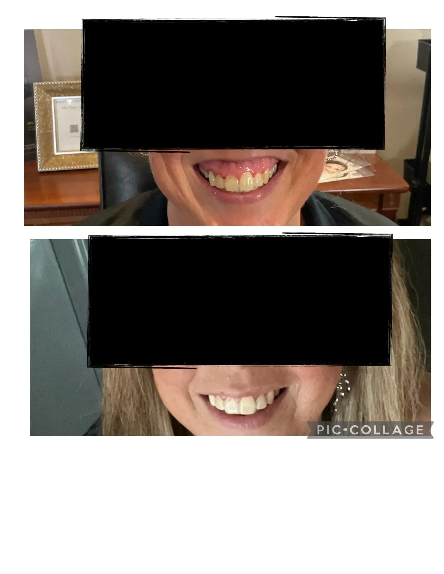 Side-by-side close-ups of two smiling mouths, one with discolored teeth and one with whiter teeth.