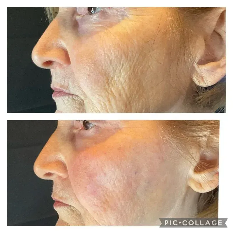 Side-by-side close-ups of a face profile, showing skin texture and wrinkles, with an orange tint in the lower image