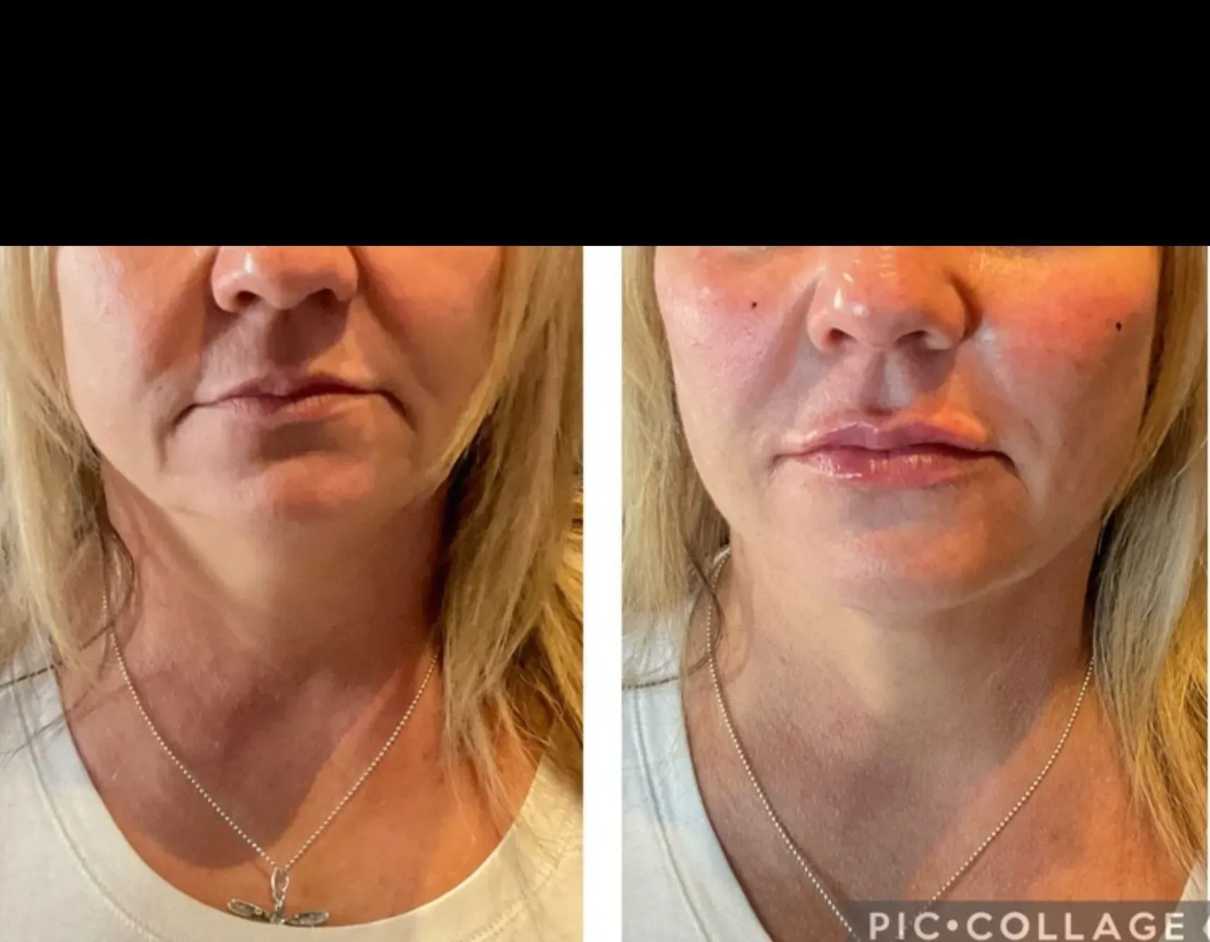 Side-by-side close-up of a woman’s lower face and neck wearing a necklace, before and after comparison.