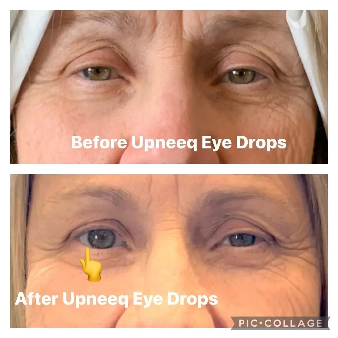 Before-and-after collage of under-eye area with “Upneeq Eye Drops” text, showing droopy eyelid improvement