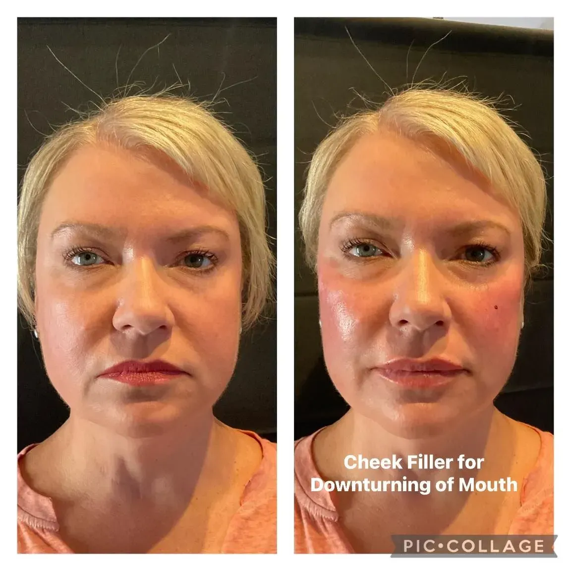 Side-by-side face photos comparing cheek filler before and after, with after image.