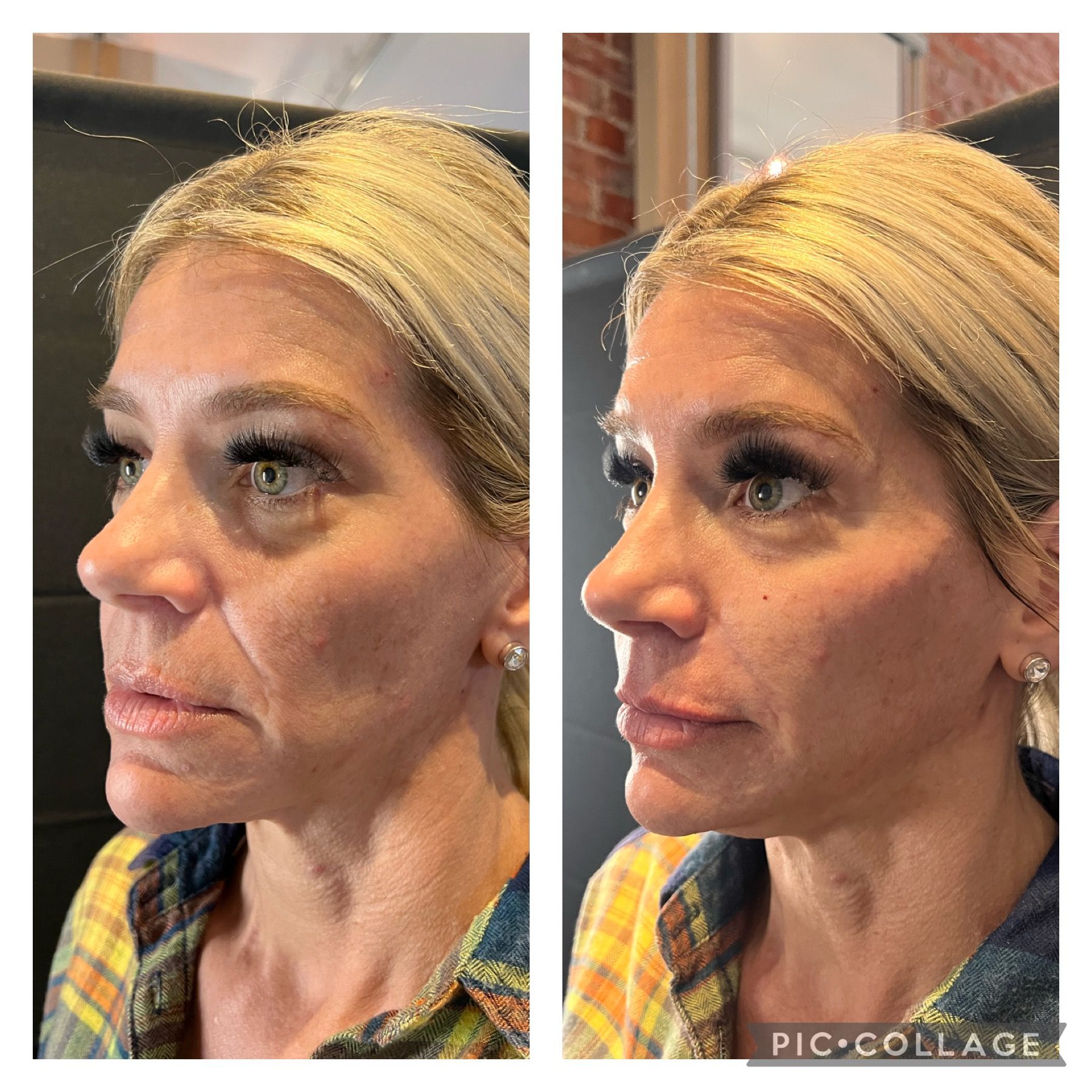 Side-by-side profile photos of a blonde woman indoors, showing before-and-after facial appearance.