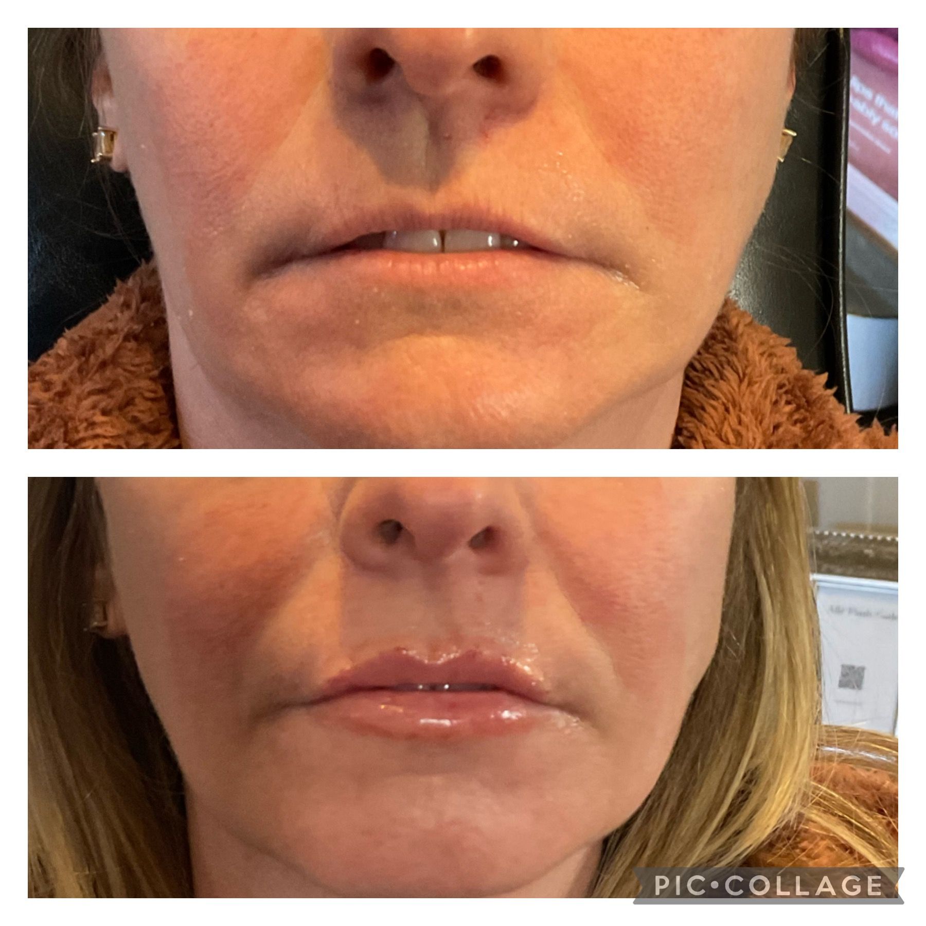 Close-up before-and-after of lips and lower face, showing smoother, glossier lips in the bottom image