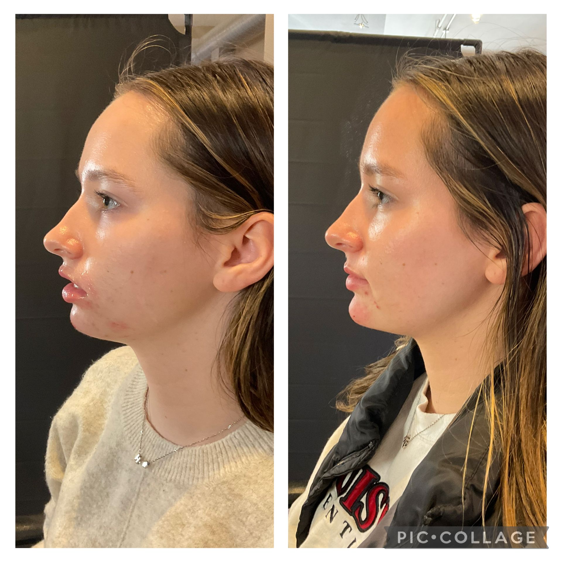Side-by-side profile photos of a woman indoors, showing a visible facial before-and-after comparison.