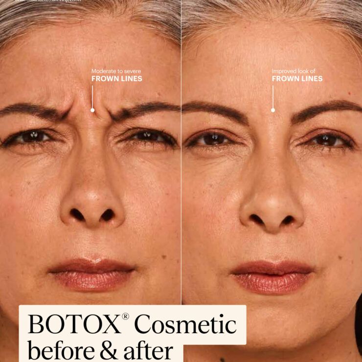 Before-and-after face with reduced frown lines; Botox Cosmetic ad.