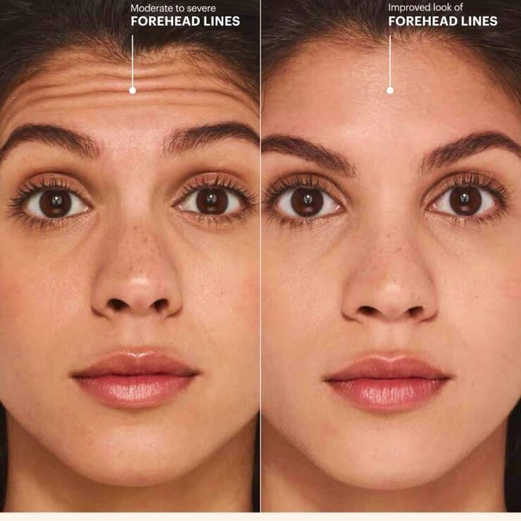 Side-by-side face close-up showing forehead lines before and after smoothing treatment