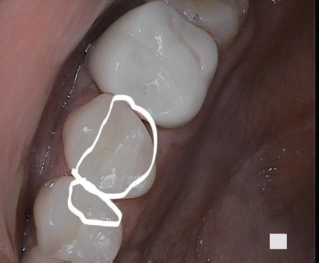 A close up of a tooth with a white line drawn on it