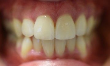A close up of a person 's teeth with white teeth.