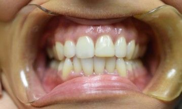 A close up of a person 's mouth with white teeth.