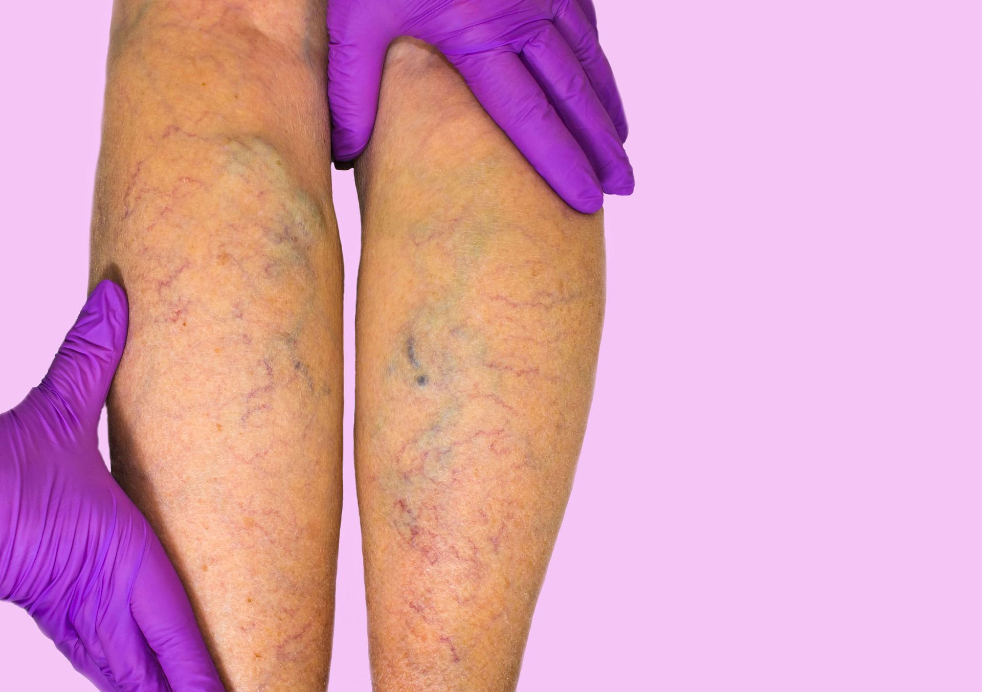 varicose veins