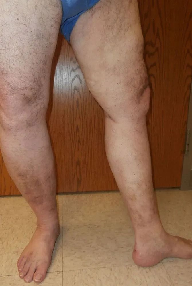 Person's legs; skin shows bruising. Standing, facing forward, one leg slightly bent. Light and dark brown tones.