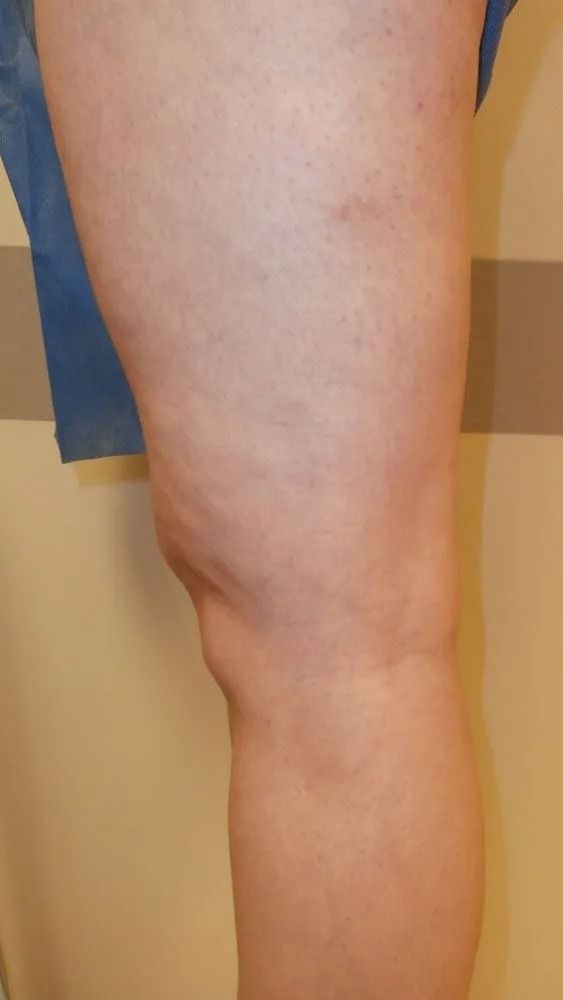 Leg with visible veins, possibly showing signs of varicose veins or other vascular issues.